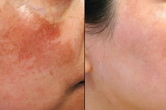 Before After - 1