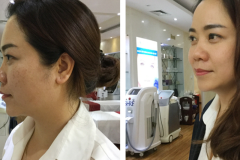 Before After - 2
