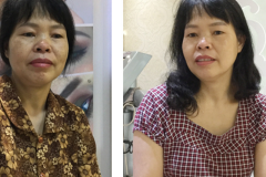 Before After - 4