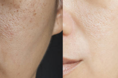 Before After - 5