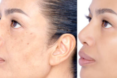 Before After - 6